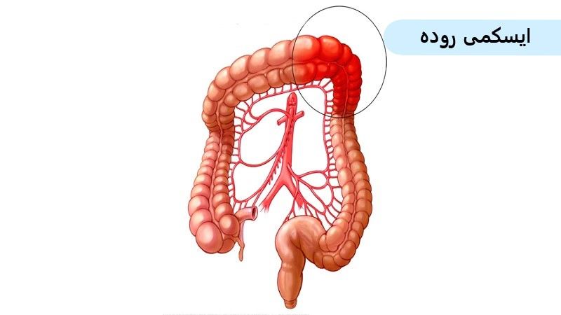 علت بیماری گوارشی ایسکمی روده و راه درمان آن